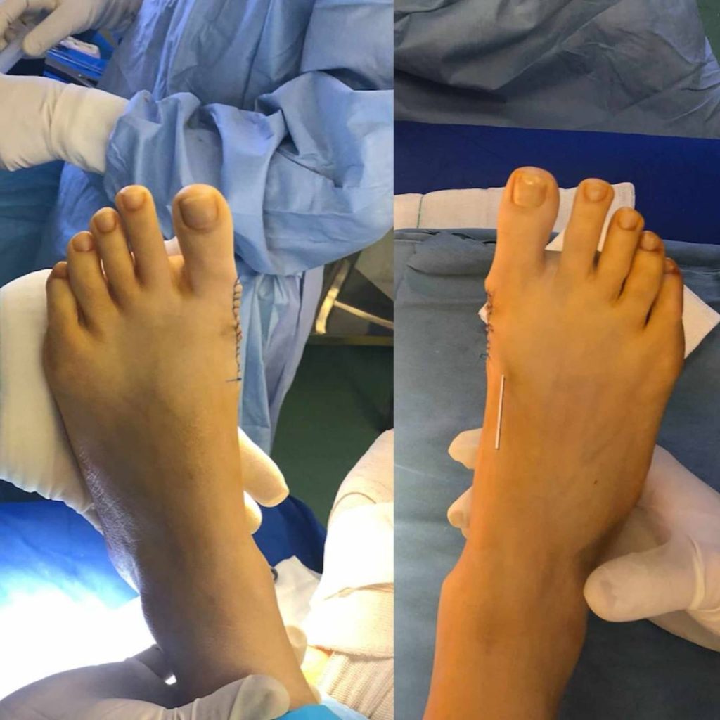 Hallux Valgus (Post-) Operation